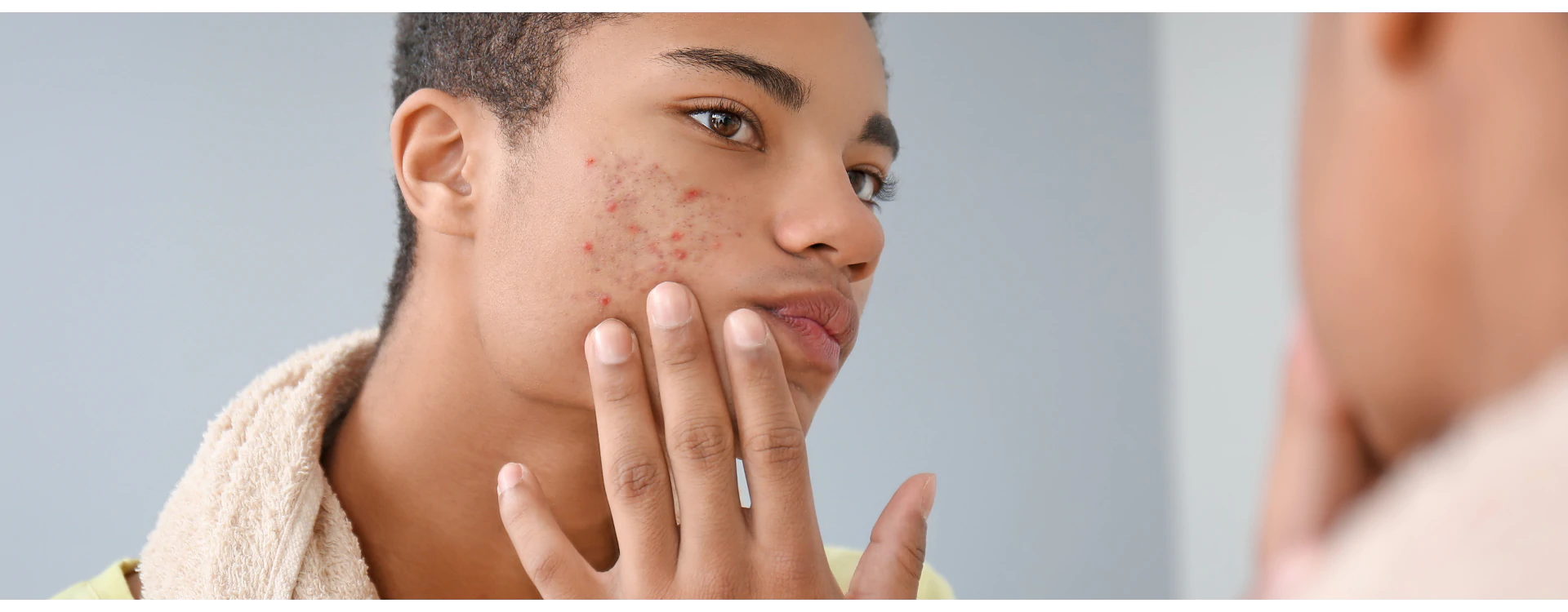 How to take care of dry acne skin? Tips and products to help maintain How to take care of dry acne skin? Tips and products to help maintain