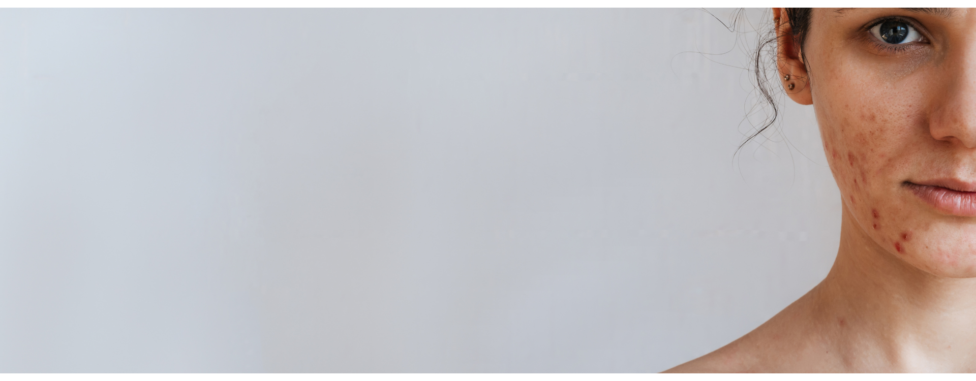 Jaki peeling do cery trądzikowej? Porady i produkty, które pomogą utrzymać Twoją skórę w dobrej kondycji